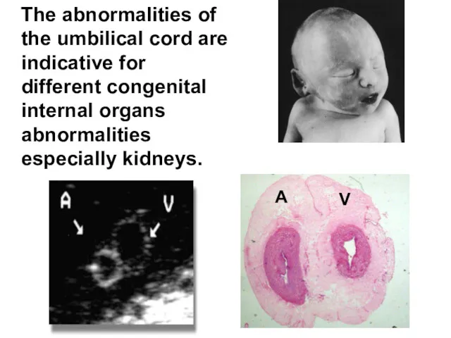 The abnormalities of the umbilical cord are indicative for different