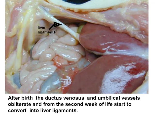 After birth the ductus venosus and umbilical vessels obliterate and