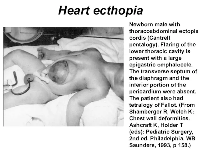 Heart ecthopia Newborn male with thoracoabdominal ectopia cordis (Cantrell pentalogy).