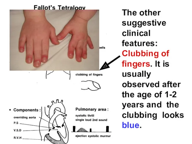 The other suggestive clinical features: Clubbing of fingers. It is