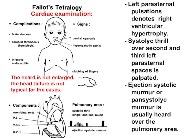 - Left parasternal pulsations denotes right ventricular hypertrophy. - Systolyc