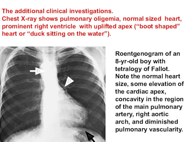 The additional clinical investigations. Chest X-ray shows pulmonary oligemia, normal