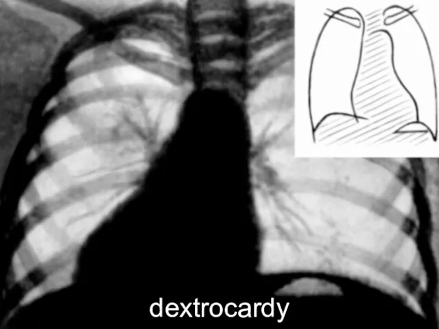 dextrocardy