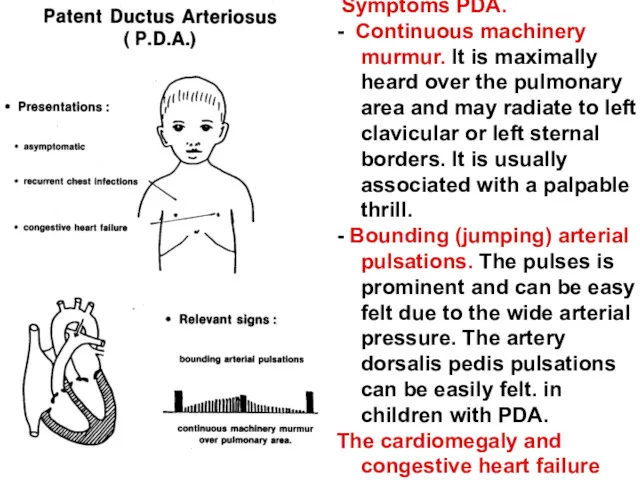 Symptoms PDA. - Continuous machinery murmur. It is maximally heard