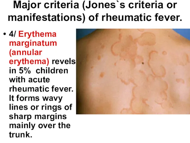 Major criteria (Jones`s criteria or manifestations) of rheumatic fever. 4/