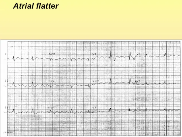 Atrial flatter