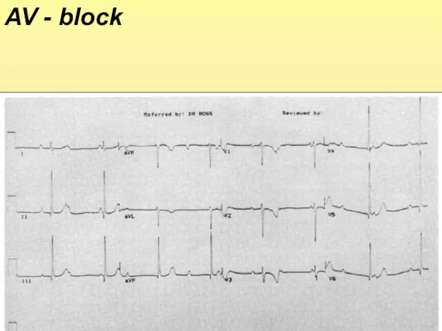 AV - block