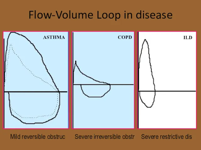 Flow-Volume Loop in disease Mild reversible obstruc Severe irreversible obstr Severe restrictive dis ASTHMA COPD ILD