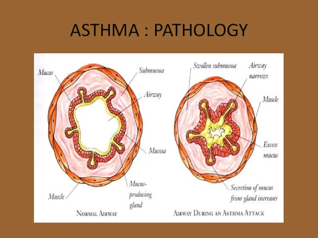 ASTHMA : PATHOLOGY