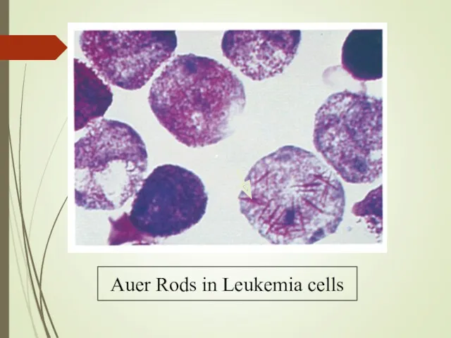Auer Rods in Leukemia cells