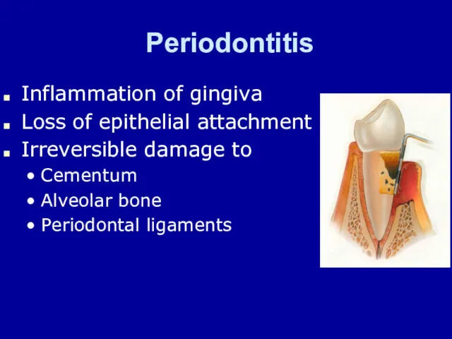 Periodontitis Inflammation of gingiva Loss of epithelial attachment Irreversible damage to Cementum Alveolar bone Periodontal ligaments