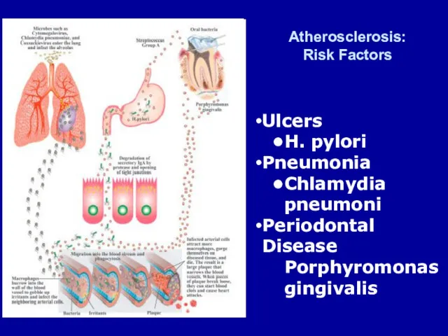 Ulcers H. pylori Pneumonia Chlamydia pneumoni Periodontal Disease Porphyromonas gingivalis Atherosclerosis: Risk Factors