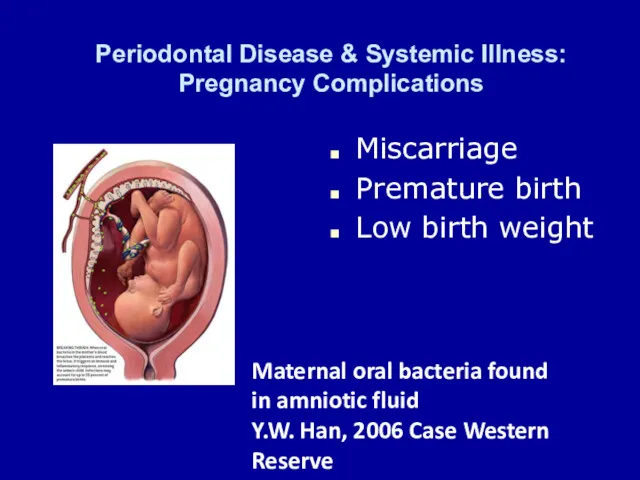 Periodontal Disease & Systemic Illness: Pregnancy Complications Miscarriage Premature birth