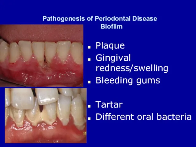 Pathogenesis of Periodontal Disease Biofilm Plaque Gingival redness/swelling Bleeding gums Tartar Different oral bacteria