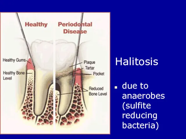 Halitosis due to anaerobes (sulfite reducing bacteria)