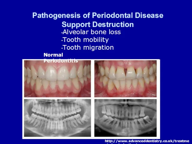 Pathogenesis of Periodontal Disease Support Destruction Alveolar bone loss Tooth mobility Tooth migration Normal Periodontitis http://www.advanceddentistry.co.uk/treatments/periodontics/