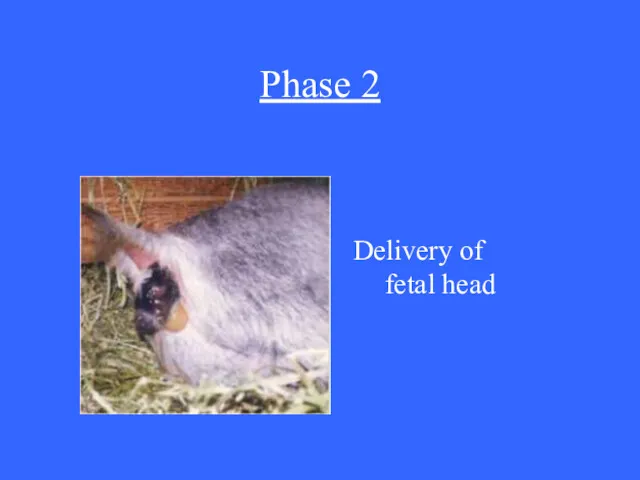 Phase 2 Delivery of fetal head