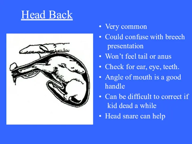 Head Back Very common Could confuse with breech presentation Won’t feel tail or