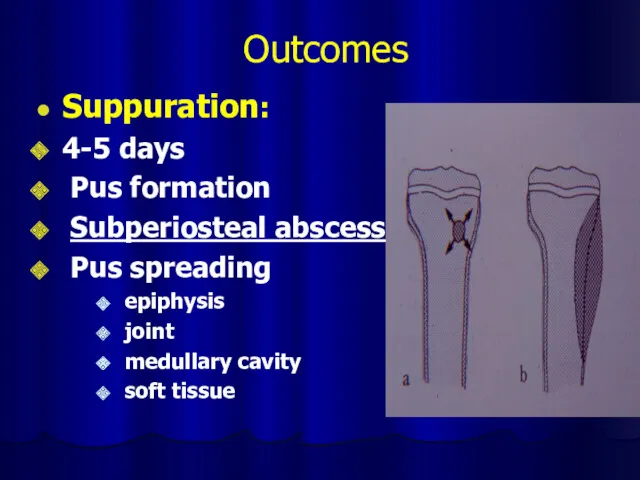 Outcomes Suppuration: 4-5 days Pus formation Subperiosteal abscess Pus spreading epiphysis joint medullary cavity soft tissue