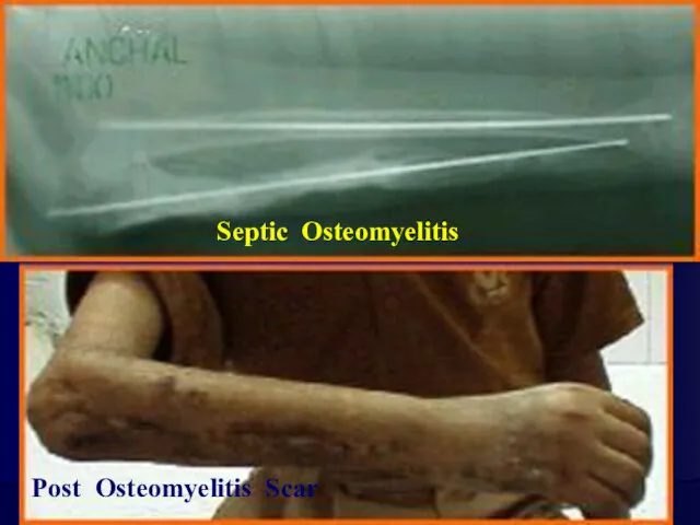 Septic Osteomyelitis Post Osteomyelitis Scar