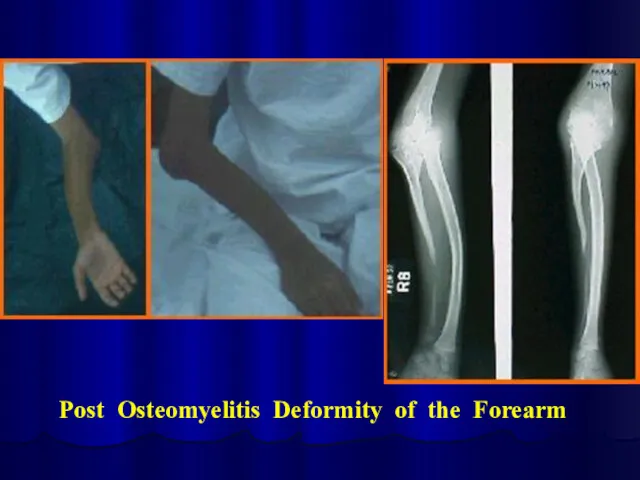 Post Osteomyelitis Deformity of the Forearm