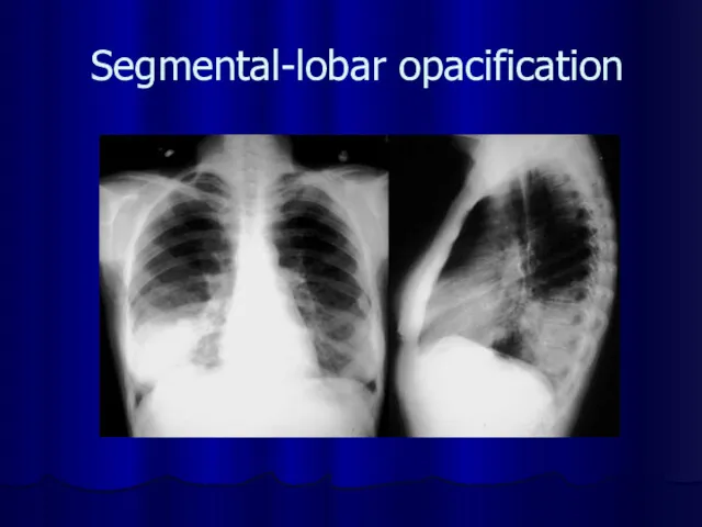 Segmental-lobar opacification