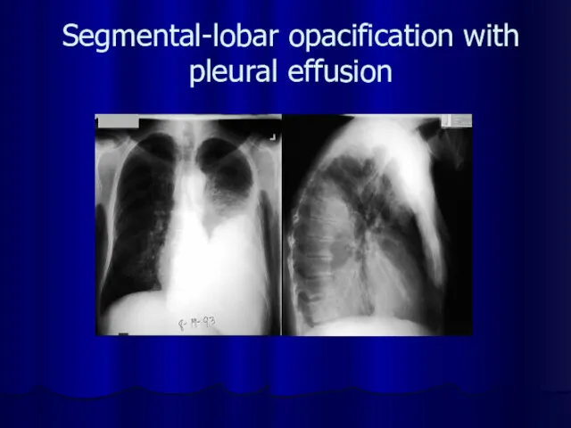 Segmental-lobar opacification with pleural effusion