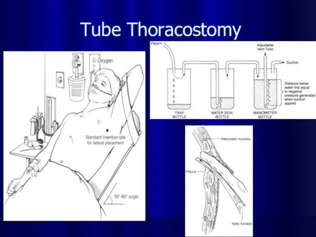 Tube Thoracostomy