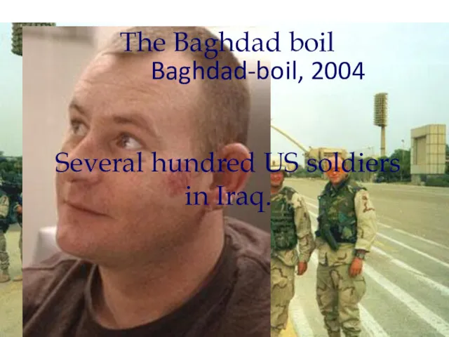 The Baghdad boil Baghdad-boil, 2004 Several hundred US soldiers in Iraq.