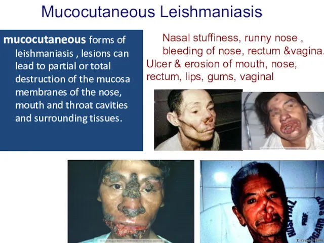 mucocutaneous forms of leishmaniasis , lesions can lead to partial