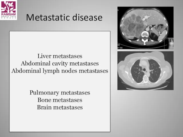 Metastatic disease Liver metastases Abdominal cavity metastases Abdominal lymph nodes