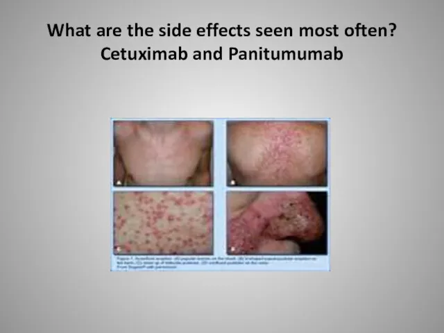 What are the side effects seen most often? Cetuximab and Panitumumab