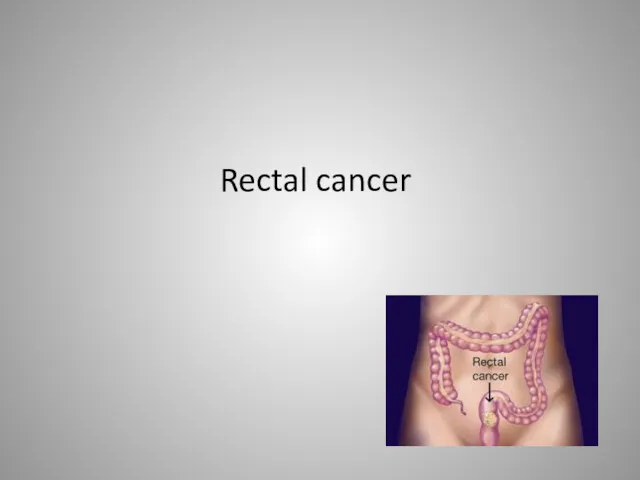 Rectal cancer