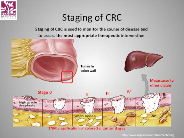 Staging of CRC is used to monitor the course of
