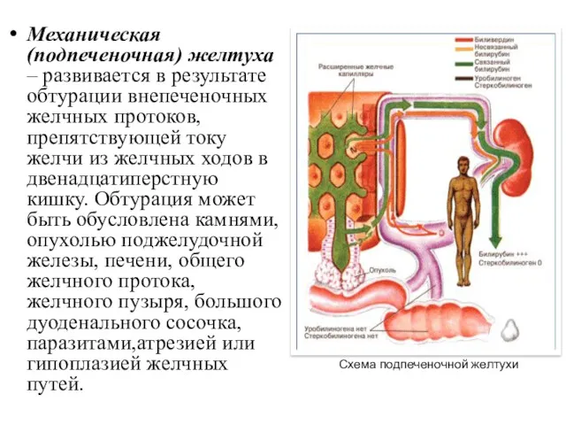 Механическая (подпеченочная) желтуха – развивается в результате обтурации внепеченочных желчных протоков, препятствующей току