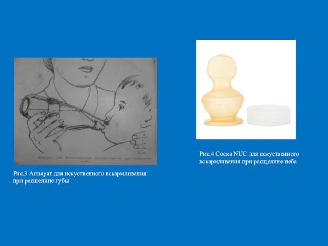 Рис.3 Аппарат для искуственного вскармливания при расщелине губы Рис.4 Соска
