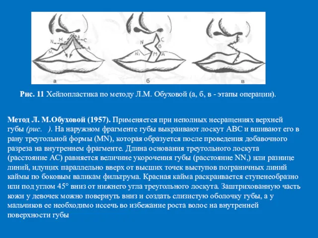 Метод Л. М.Обуховой (1957). Применяется при неполных несращениях верхней губы