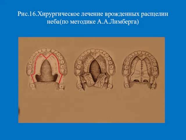 Рис.16.Хирургическое лечение врожденных расщелин неба(по методике А.А.Лимберга)