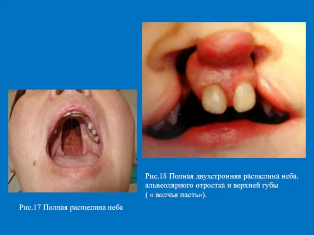 Рис.17 Полная расщелина неба Рис.18 Полная двухстронняя расщелина неба, альвеолярного