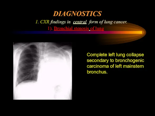 DIAGNOSTICS 1. CXR findings in central form of lung cancer.