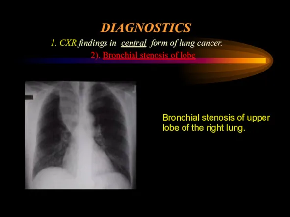 DIAGNOSTICS 1. CXR findings in central form of lung cancer.