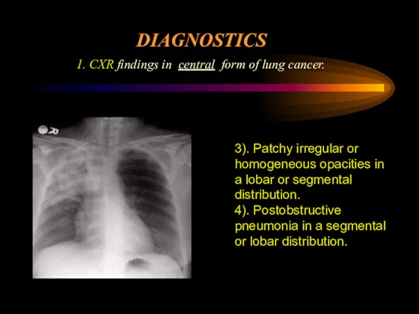 DIAGNOSTICS 1. CXR findings in central form of lung cancer.