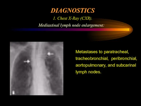 DIAGNOSTICS 1. Chest X-Ray (CXR). Mediastinal lymph node enlargement: Metastases