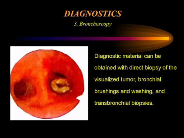 DIAGNOSTICS 3. Bronchoscopy Diagnostic material can be obtained with direct