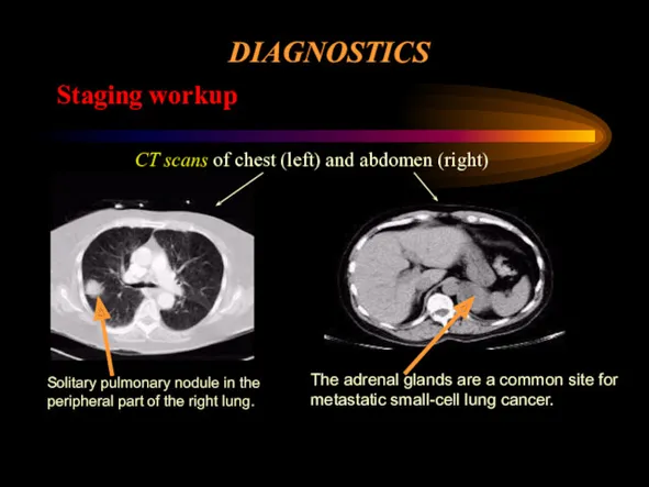 DIAGNOSTICS Staging workup CT scans of chest (left) and abdomen
