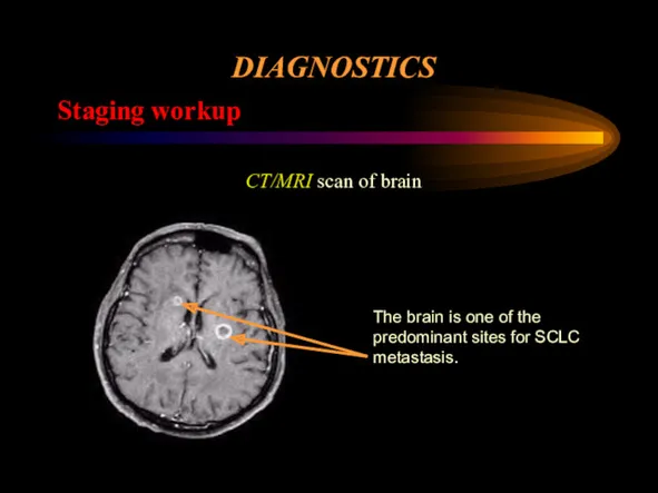 DIAGNOSTICS Staging workup CT/MRI scan of brain The brain is