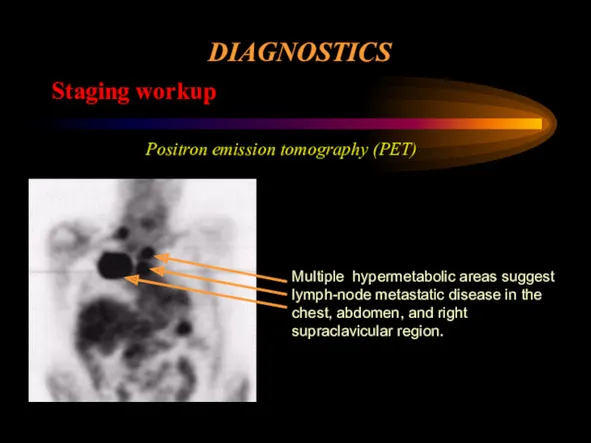 DIAGNOSTICS Staging workup Positron emission tomography (PET) Multiple hypermetabolic areas