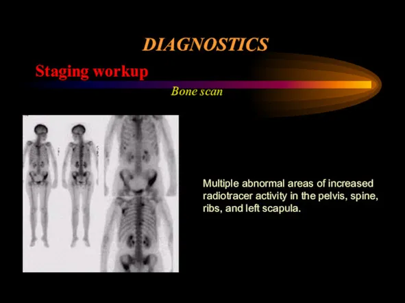 DIAGNOSTICS Staging workup Bone scan Multiple abnormal areas of increased