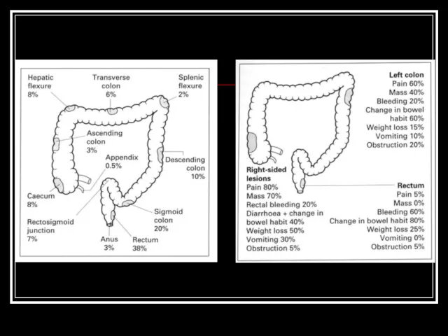 Typical sites of incidence and sympoms of colon cancer