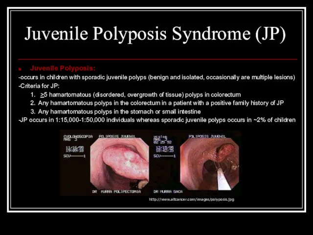 Juvenile Polyposis Syndrome (JP) Juvenile Polyposis: -occurs in children with sporadic juvenile polyps